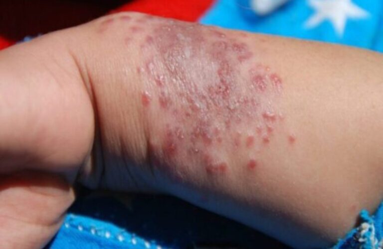 مرض - داء الليشمانيا